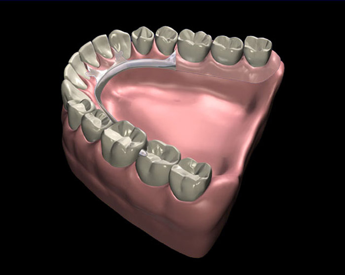 12_Removable_Partial_Denture2
